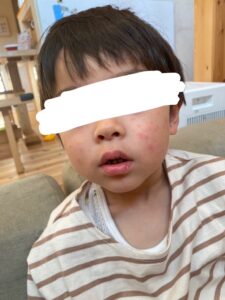 突発性発疹 顔の発疹