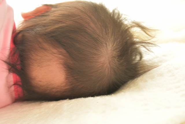 後頭部が薄くなっている赤ちゃん